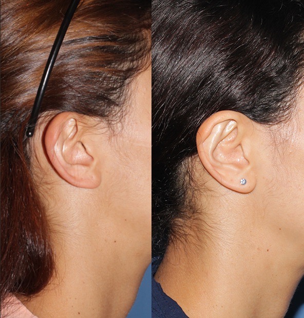 Caso 2 - Perfil Grande-OTOPLASTIA