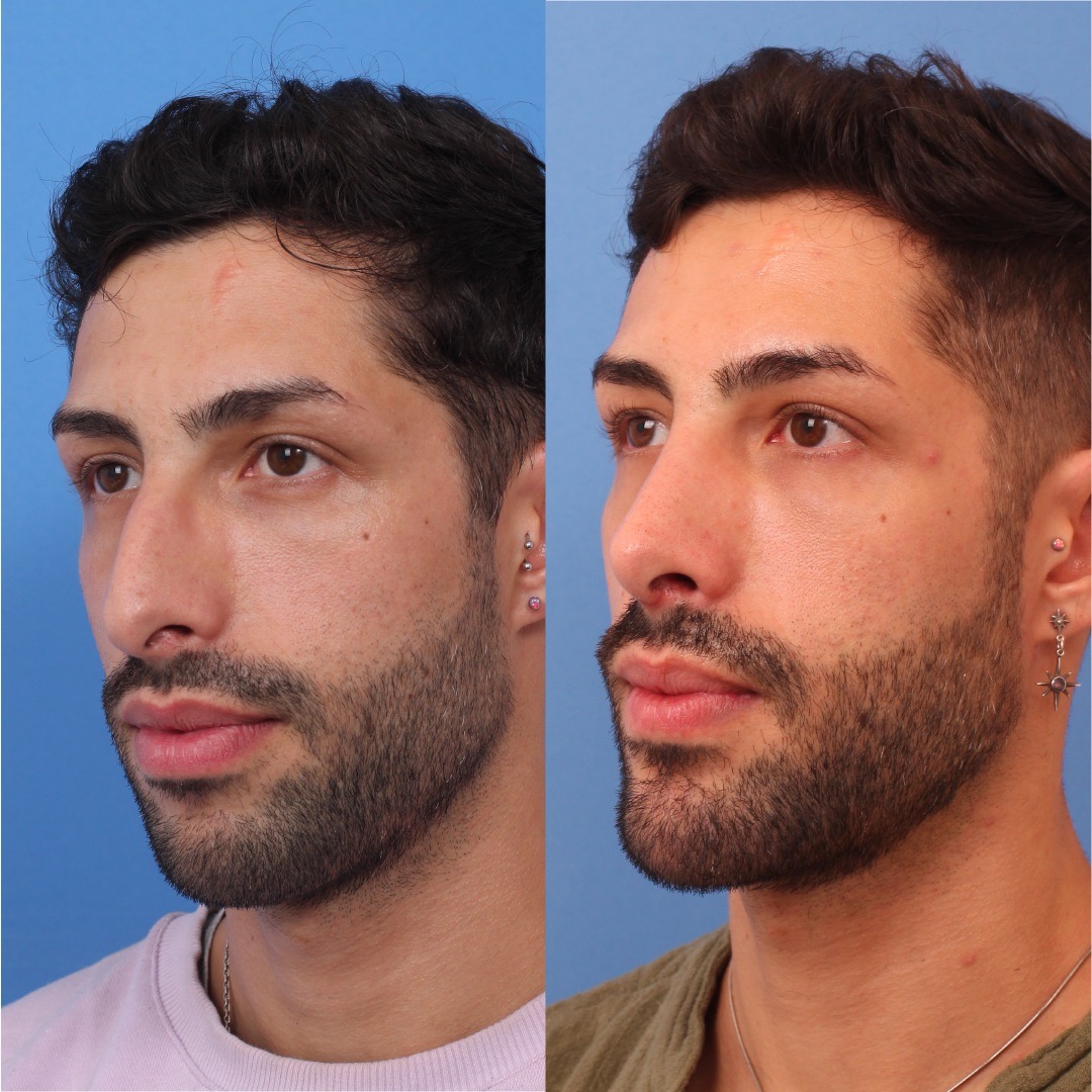 250603-perfiloplastia-01