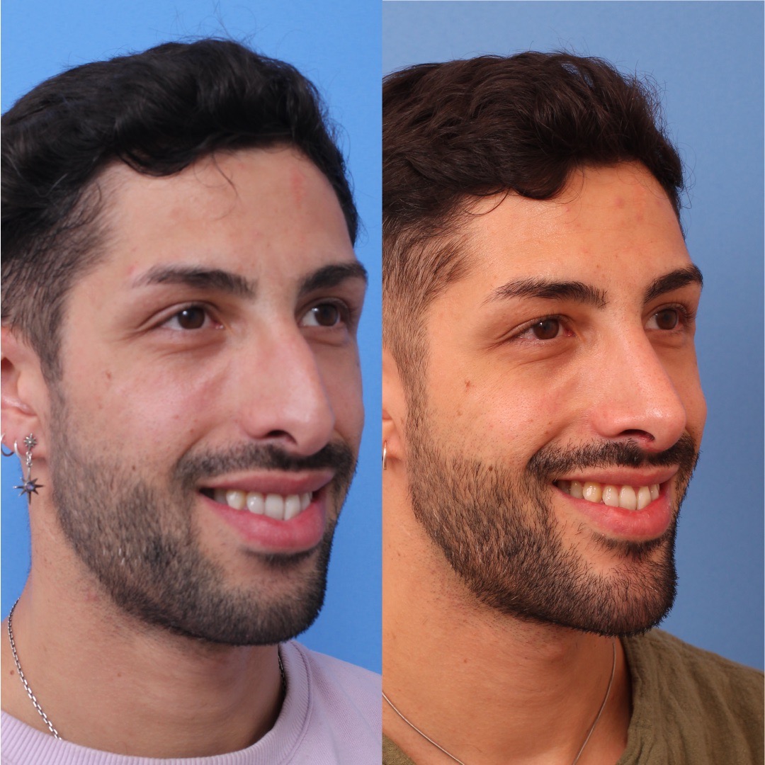 250603-perfiloplastia-03