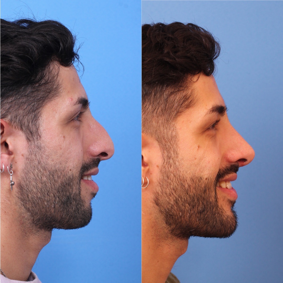 250603-perfiloplastia-04