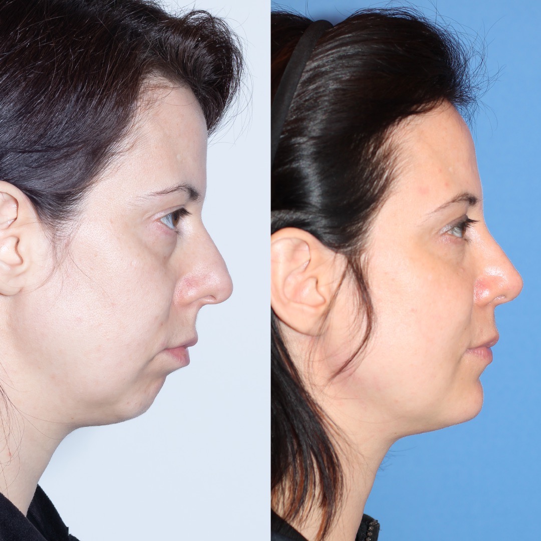 250603-perfiloplastia-09
