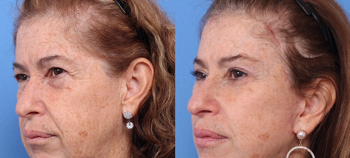 250603-rejuvenecimiento-facial-01