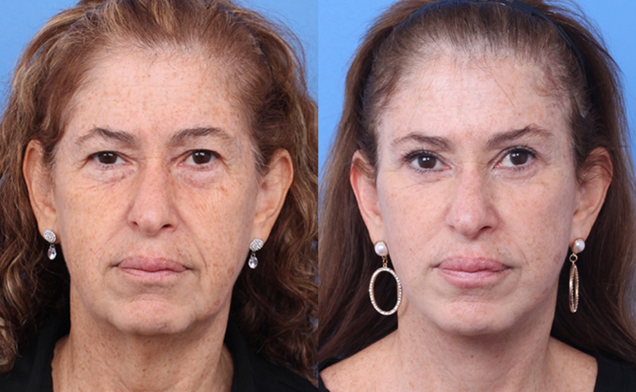 250603-rejuvenecimiento-facial-02