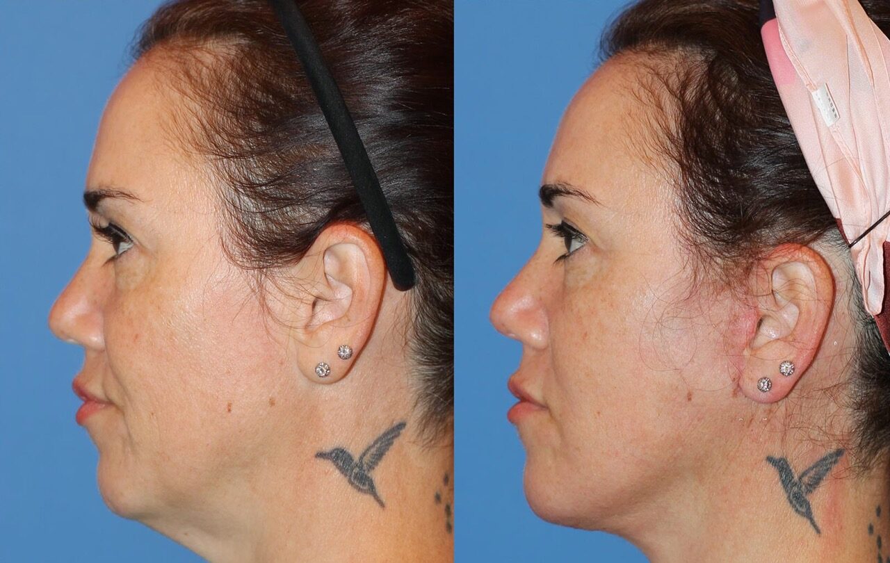 250603-rejuvenecimiento-facial-03