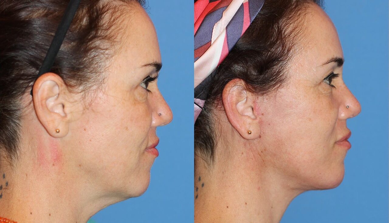 250603-rejuvenecimiento-facial-04