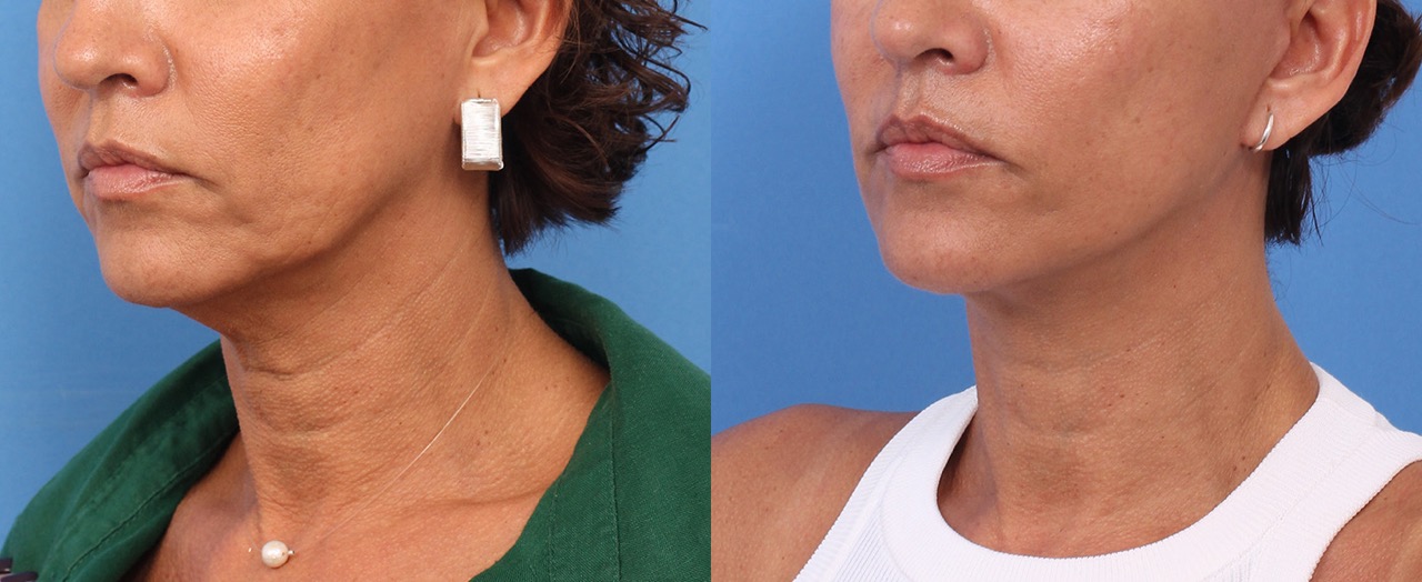 250603-rejuvenecimiento-facial-05