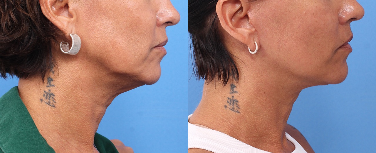 250603-rejuvenecimiento-facial-06