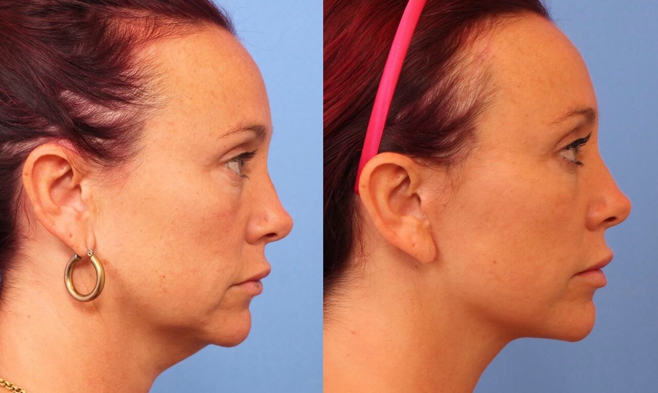 250603-rejuvenecimiento-facial-07