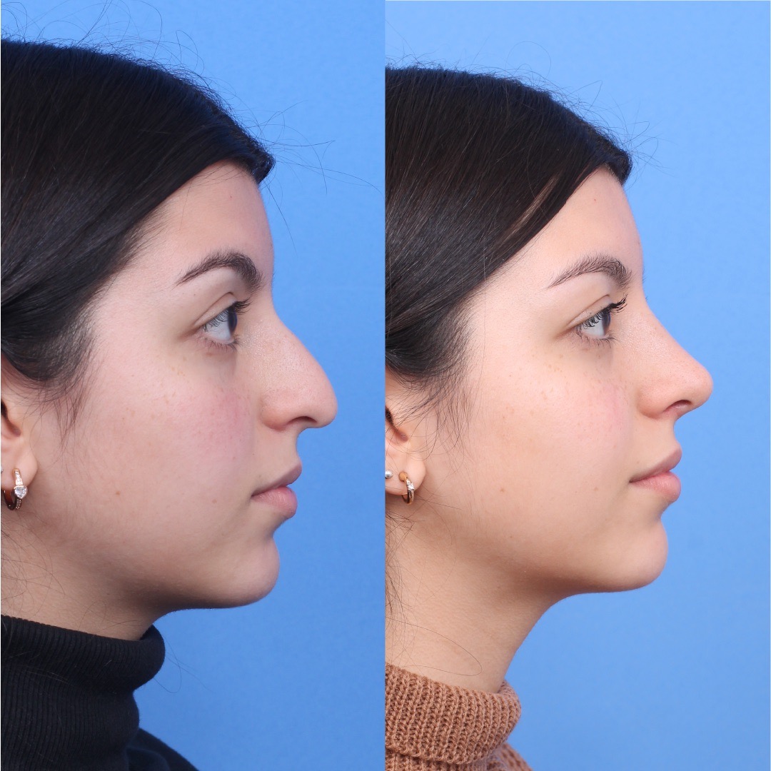 250603-rinoplastia-02