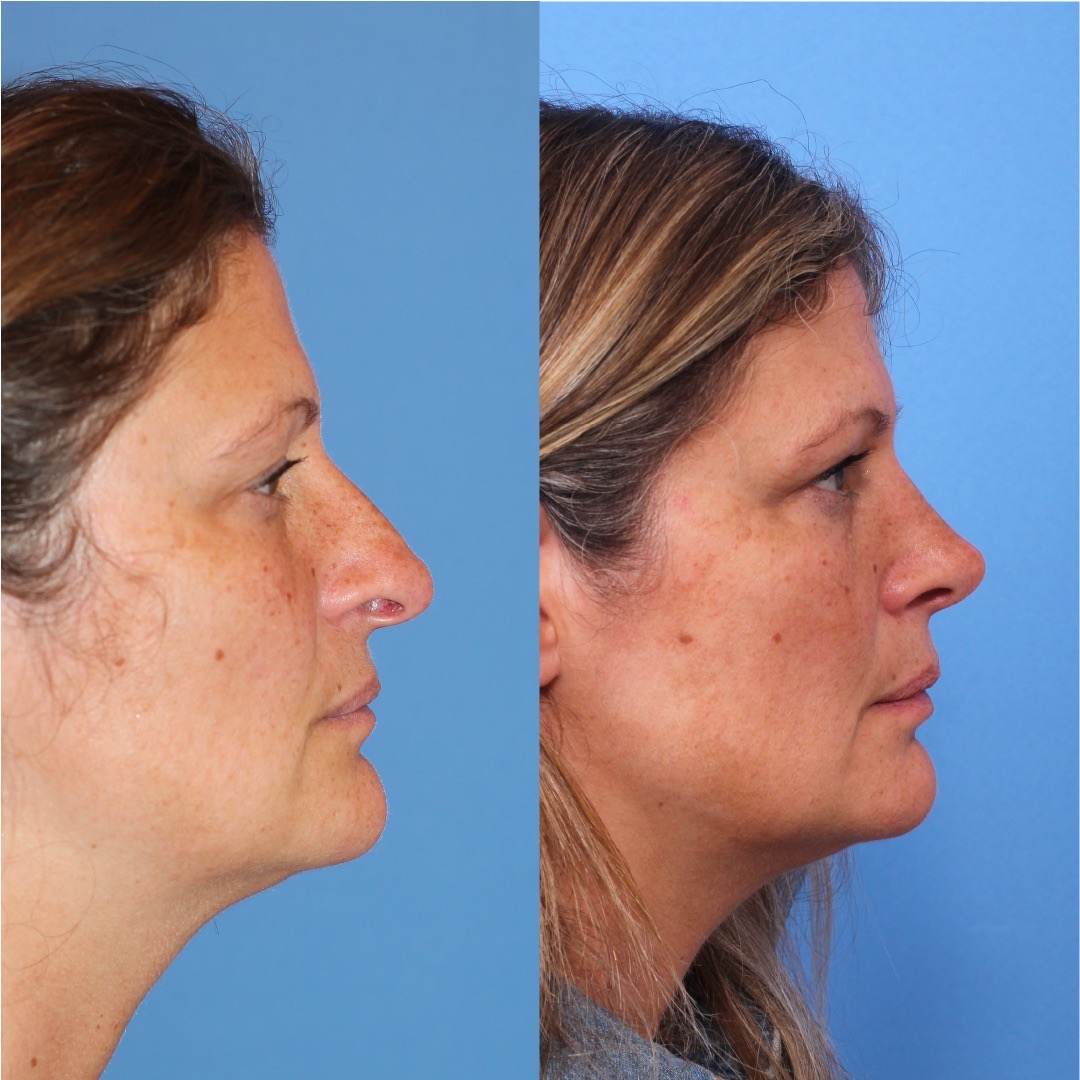 250603-rinoplastia-03