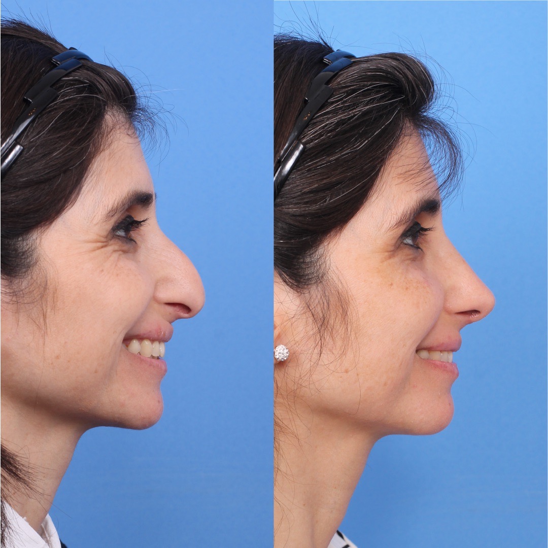 250603-rinoplastia-05