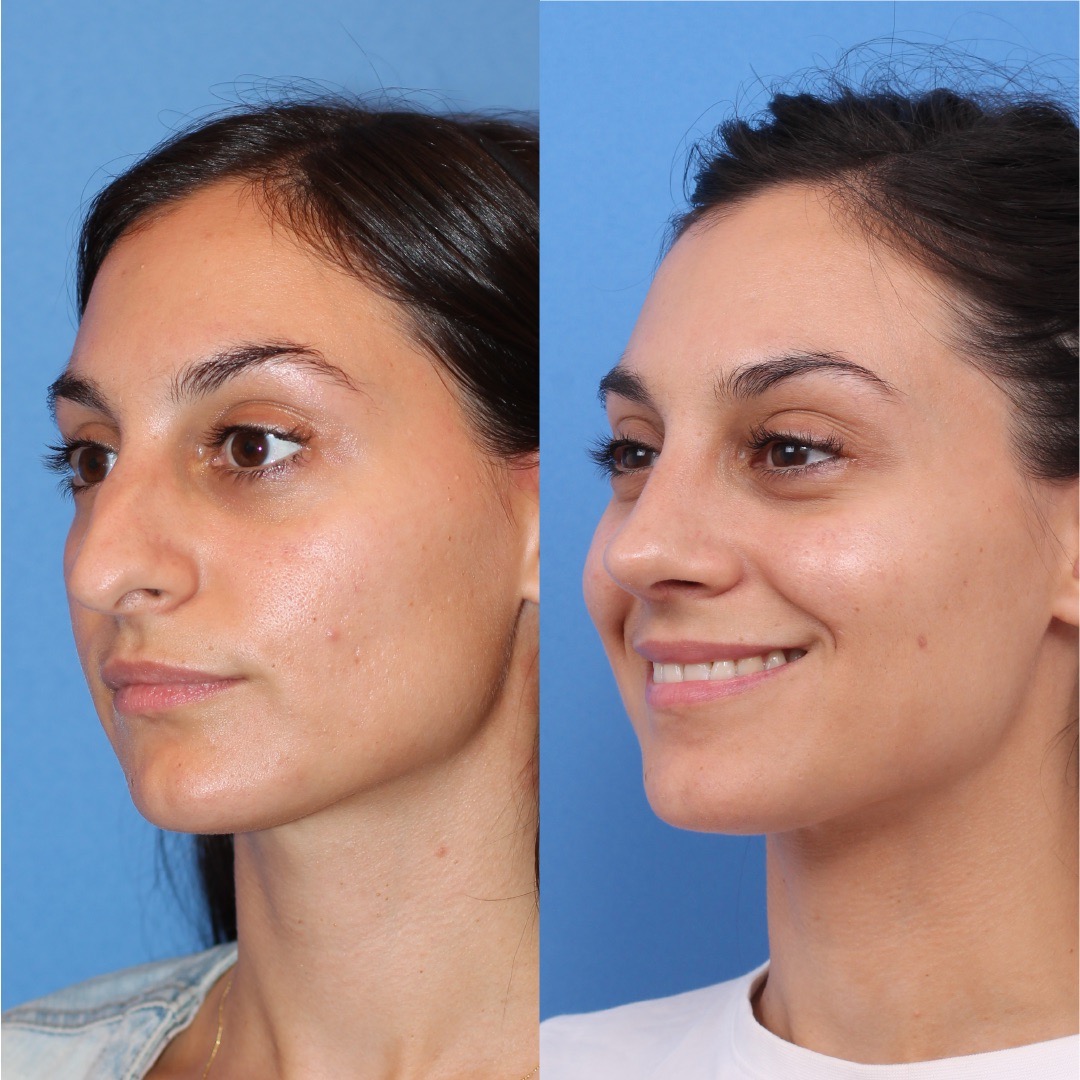 250603-rinoplastia-06