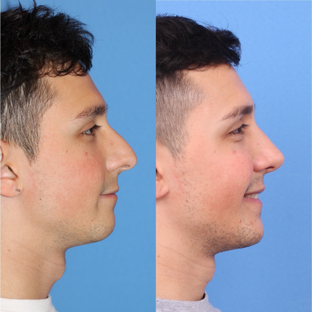 250603-rinoplastia-07