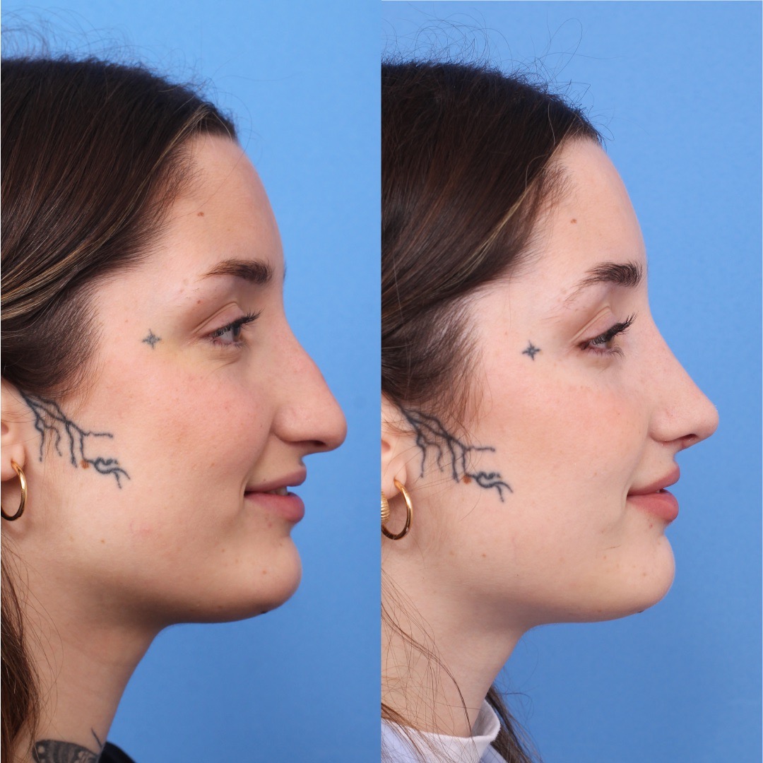 250603-rinoplastia-08